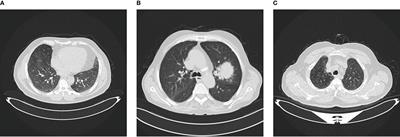 A multi-class deep learning model for early lung cancer and chronic kidney disease detection using computed tomography images